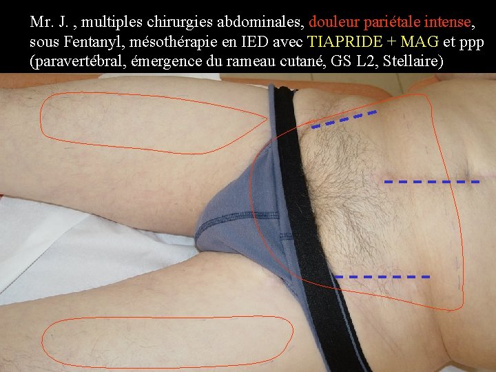 Mr. J. , multiples chirurgies abdominales, douleur pariétale intense, sous Fentanyl, mésothérapie en IED