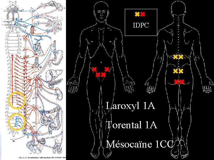 IDPC Laroxyl 1 A Torental 1 A Mésocaïne 1 CC 