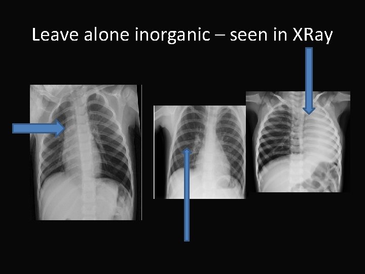 Leave alone inorganic – seen in XRay 
