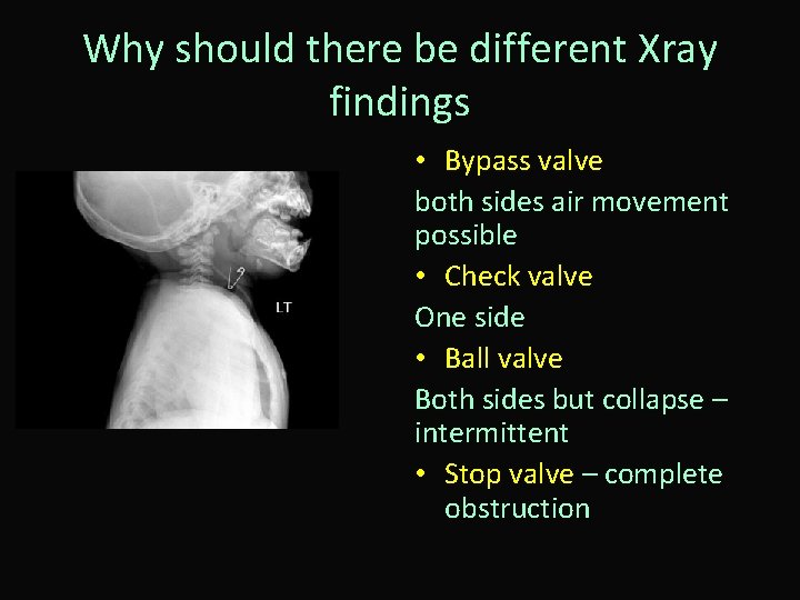 Why should there be different Xray findings • Bypass valve both sides air movement