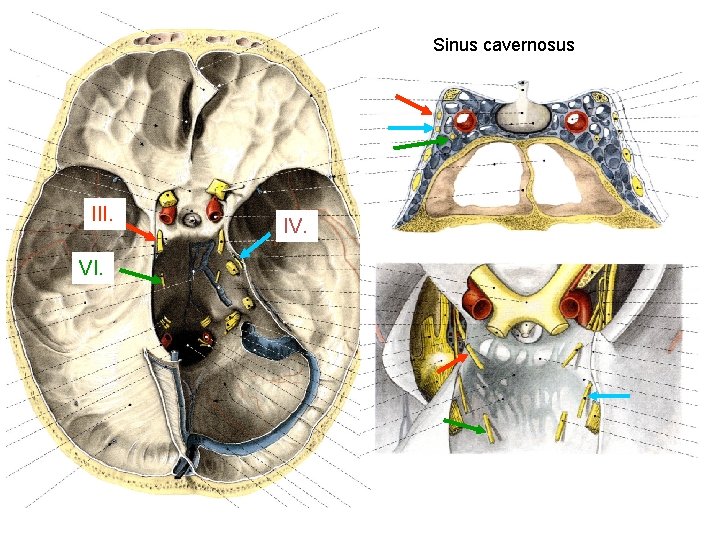 Sinus cavernosus III. VI. IV. 