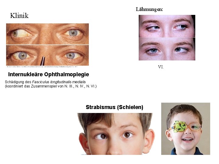 Lähmungen: Klinik VI. Internukleäre Ophthalmoplegie Schädigung des Fasciculus longitudinalis medialis (koordiniert das Zusammenspiel von
