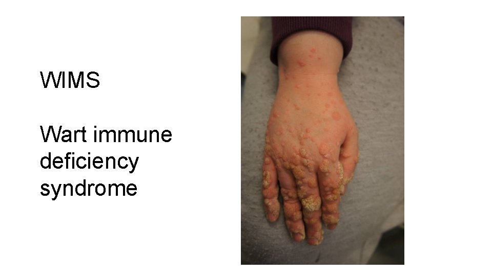 WIMS Wart immune deficiency syndrome 