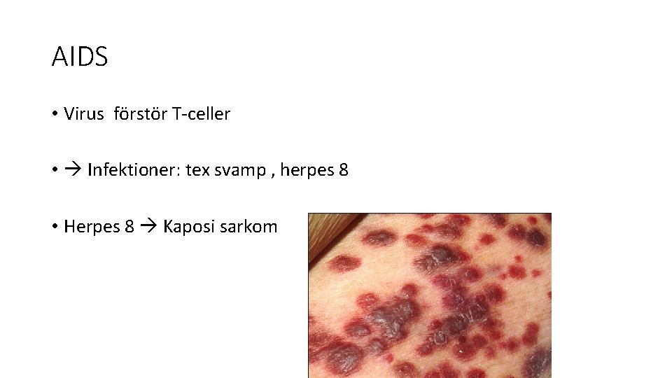 AIDS • Virus förstör T-celler • Infektioner: tex svamp , herpes 8 • Herpes