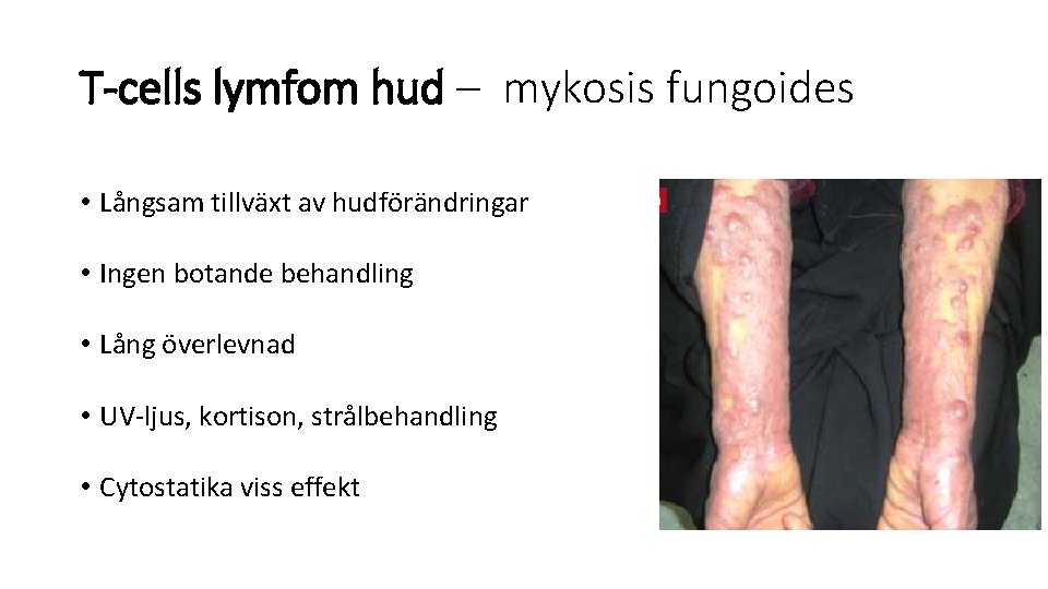 T-cells lymfom hud – mykosis fungoides • Långsam tillväxt av hudförändringar • Ingen botande