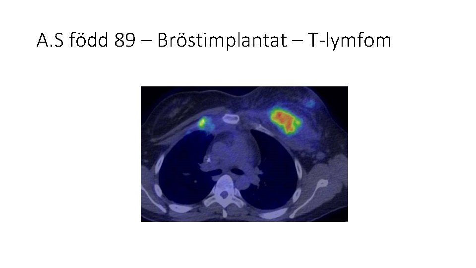 A. S född 89 – Bröstimplantat – T-lymfom 