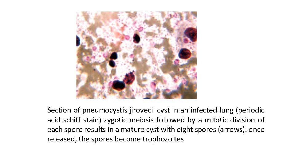 Section of pneumocystis jirovecii cyst in an infected lung (periodic acid schiff stain) zygotic