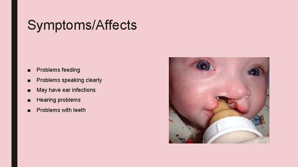 Symptoms/Affects ■ Problems feeding ■ Problems speaking clearly ■ May have ear infections ■