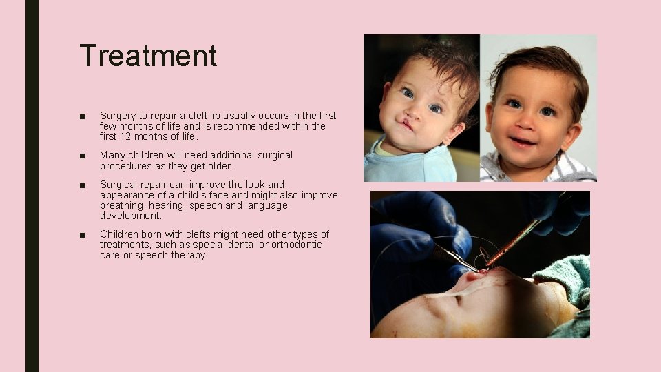Treatment ■ Surgery to repair a cleft lip usually occurs in the first few