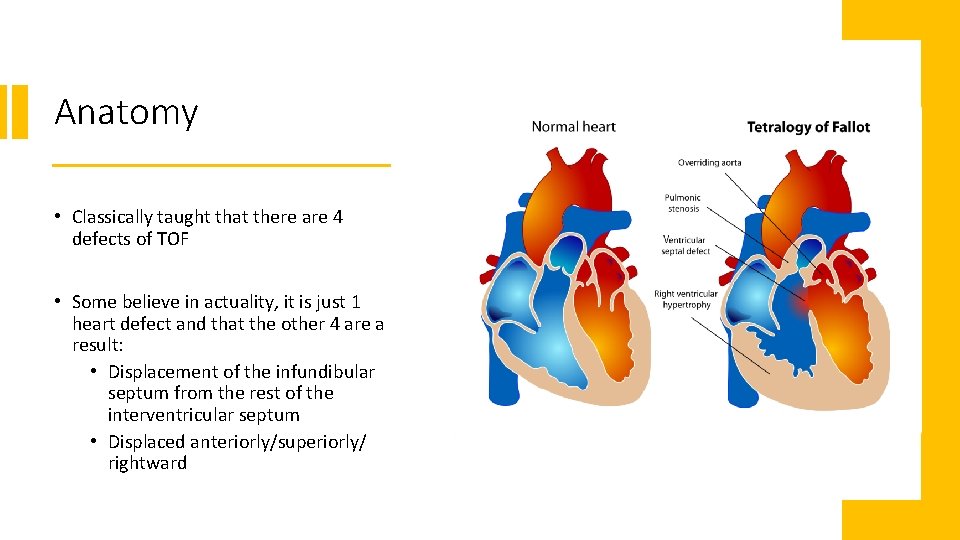 Anatomy • Classically taught that there are 4 defects of TOF • Some believe