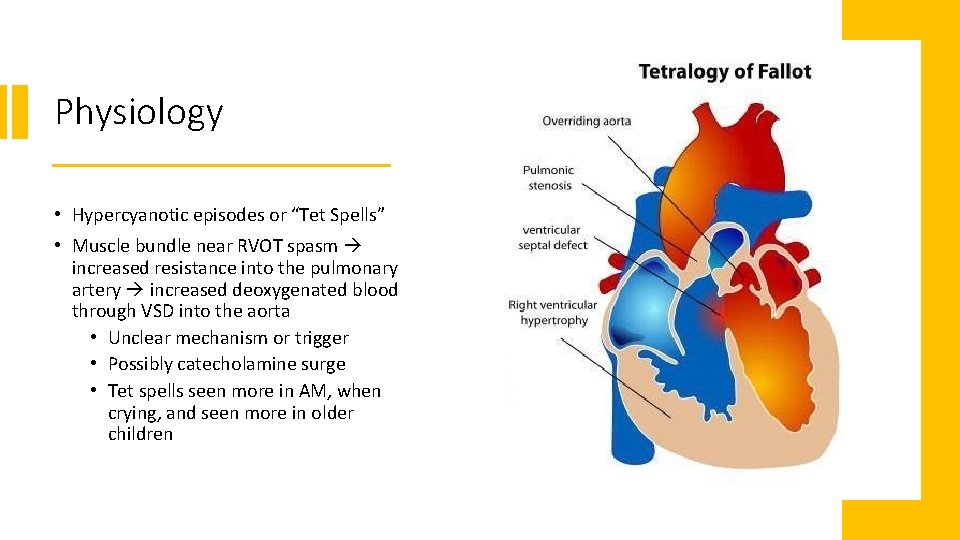 Physiology • Hypercyanotic episodes or “Tet Spells” • Muscle bundle near RVOT spasm increased