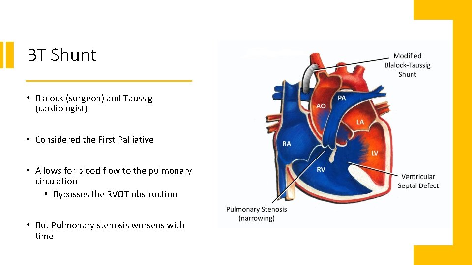 BT Shunt • Blalock (surgeon) and Taussig (cardiologist) • Considered the First Palliative •