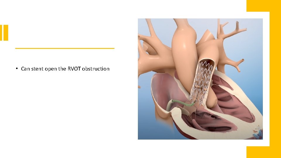  • Can stent open the RVOT obstruction 