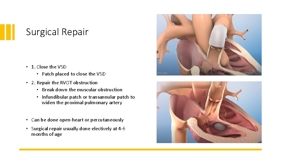 Surgical Repair • 1. Close the VSD • Patch placed to close the VSD