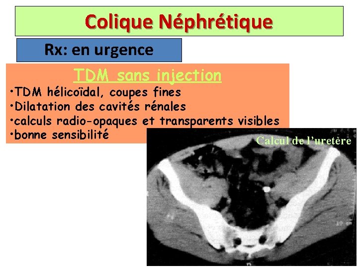 Colique Néphrétique Rx: en urgence TDM sans injection • TDM hélicoïdal, coupes fines •