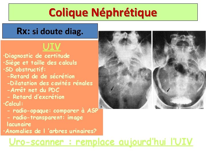 Colique Néphrétique Rx: si doute diag. UIV • Diagnostic de certitude • Siège et