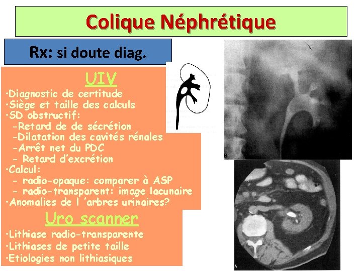 Colique Néphrétique Rx: si doute diag. UIV • Diagnostic de certitude • Siège et