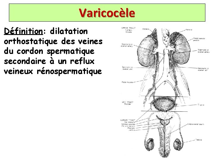 Varicocèle Définition: dilatation orthostatique des veines du cordon spermatique secondaire à un reflux veineux