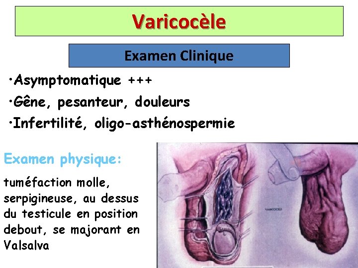 Varicocèle Examen Clinique • Asymptomatique +++ • Gêne, pesanteur, douleurs • Infertilité, oligo-asthénospermie Examen