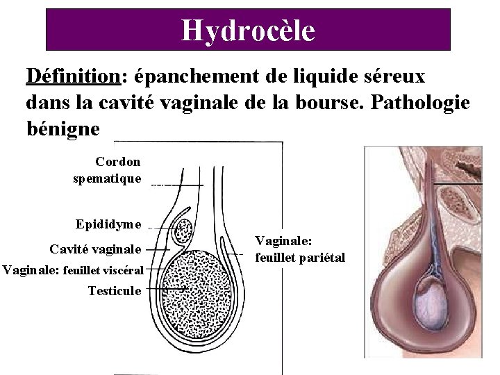 Hydrocèle Définition: épanchement de liquide séreux dans la cavité vaginale de la bourse. Pathologie