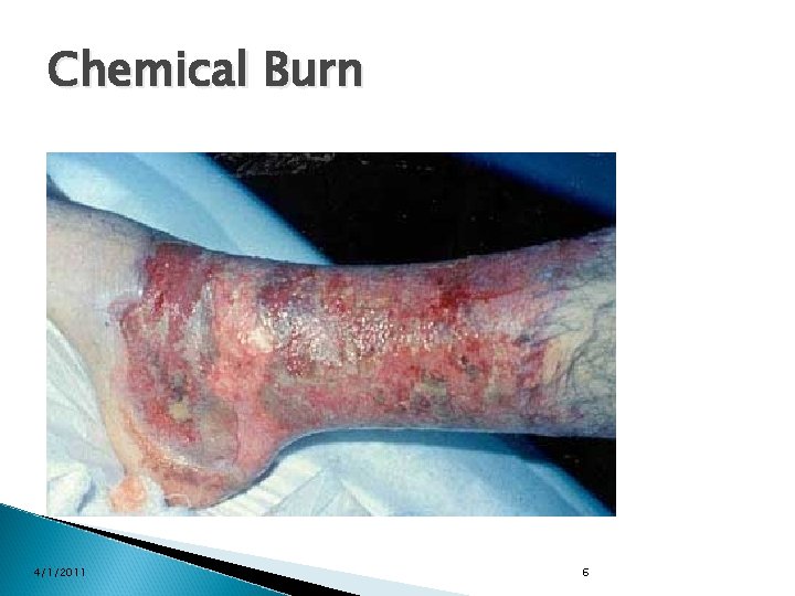 Chemical Burn 4/1/2011 6 