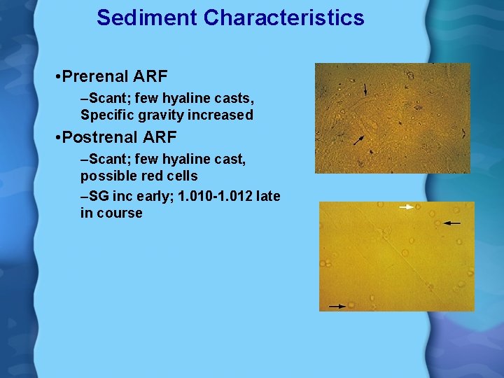 Sediment Characteristics • Prerenal ARF –Scant; few hyaline casts, Specific gravity increased • Postrenal