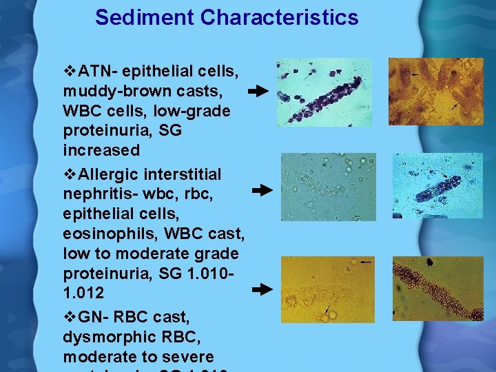 Sediment Characteristics v. ATN- epithelial cells, muddy-brown casts, WBC cells, low-grade proteinuria, SG increased