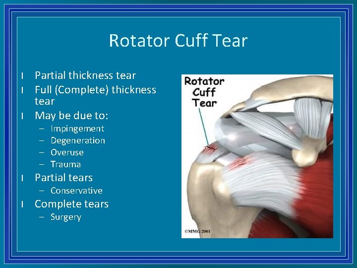 Rotator Cuff Tear l l l Partial thickness tear Full (Complete) thickness tear May
