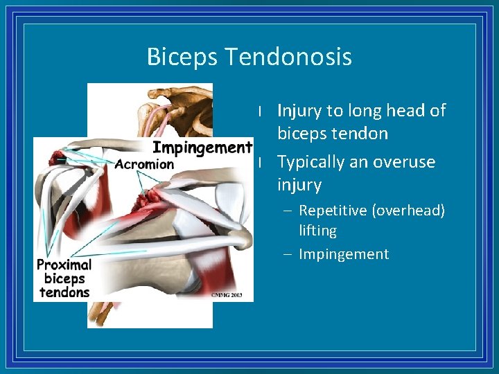 Biceps Tendonosis l l Injury to long head of biceps tendon Typically an overuse