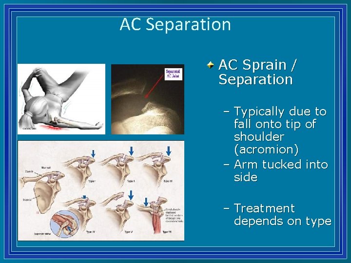 AC Separation AC Sprain / Separation – Typically due to fall onto tip of