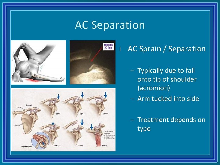 AC Separation l AC Sprain / Separation – Typically due to fall onto tip