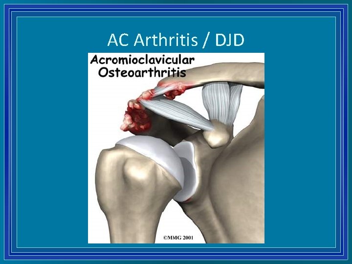 AC Arthritis / DJD 