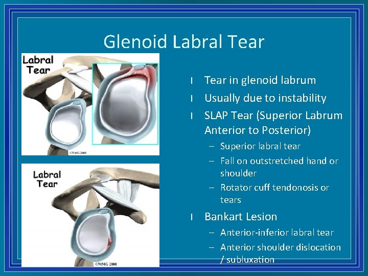 Glenoid Labral Tear l l l Tear in glenoid labrum Usually due to instability