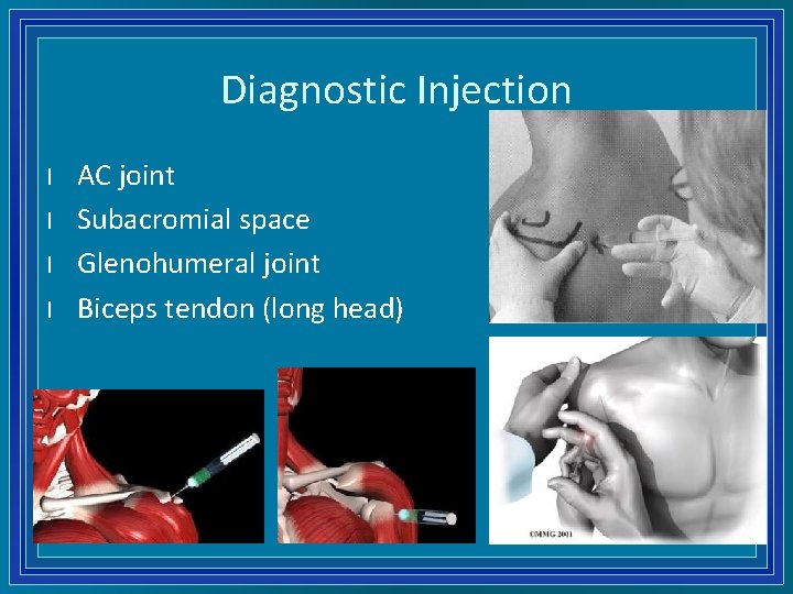 Diagnostic Injection l l AC joint Subacromial space Glenohumeral joint Biceps tendon (long head)