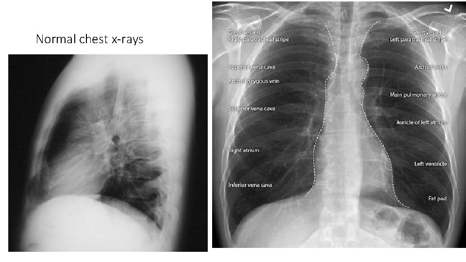 Normal chest x-rays 