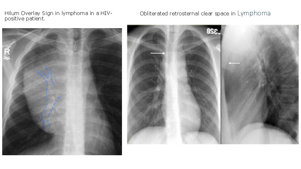 Hilum Overlay Sign in lymphoma in a HIVpositive patient. Obliterated retrosternal clear space in