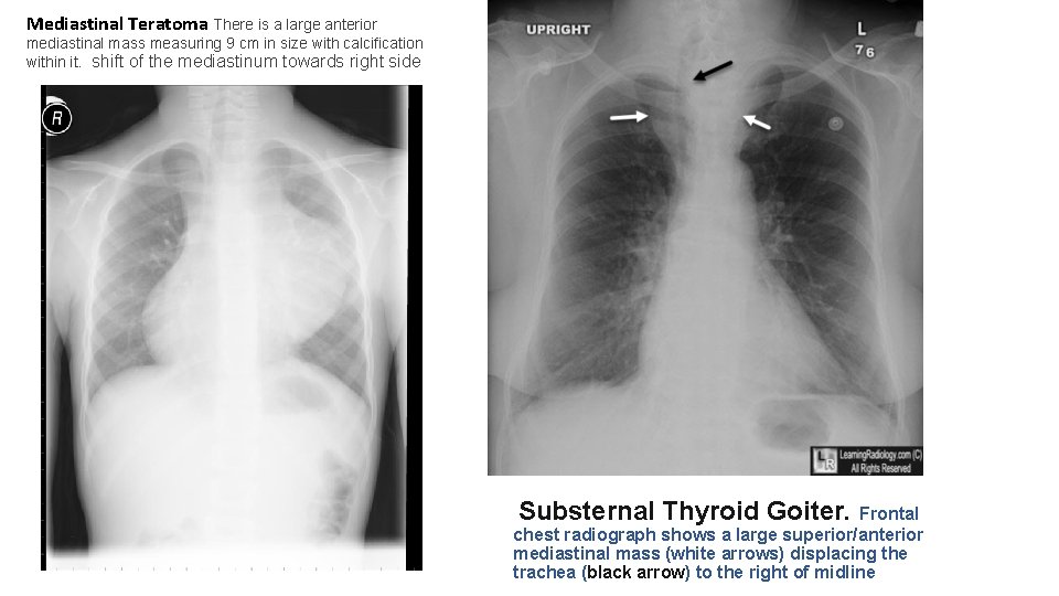 Mediastinal Teratoma There is a large anterior mediastinal mass measuring 9 cm in size