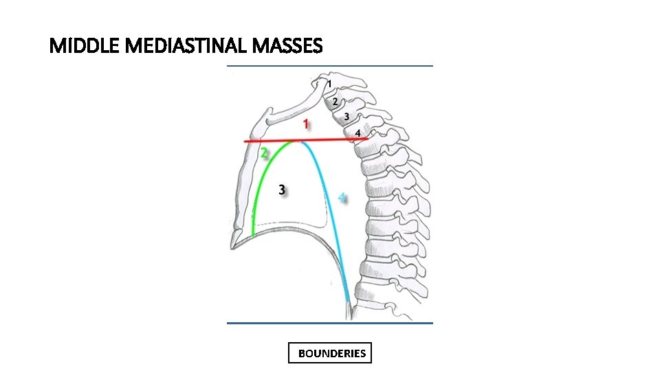 MIDDLE MEDIASTINAL MASSES BOUNDERIES 