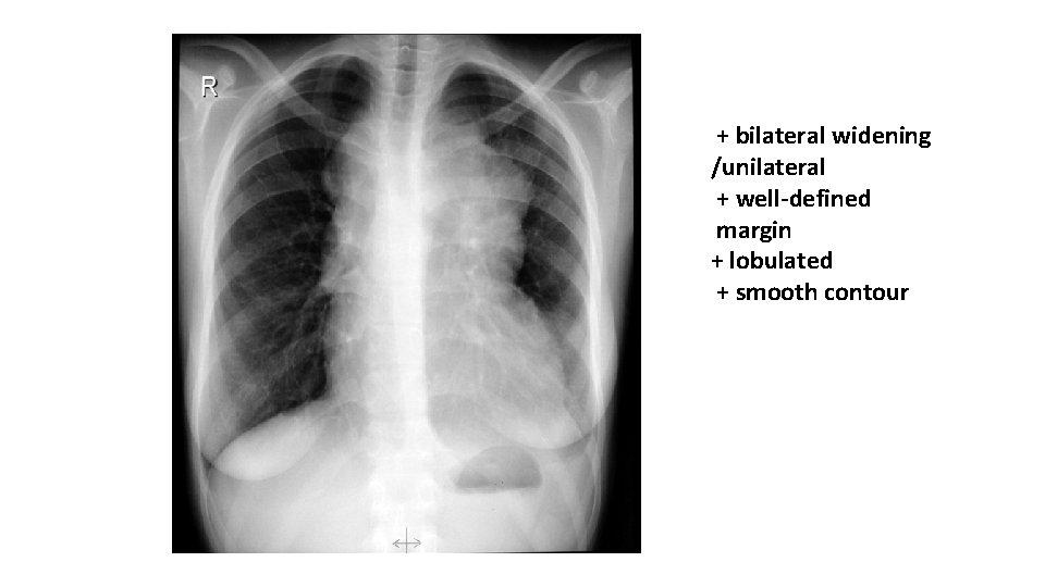 + bilateral widening /unilateral + well-defined margin + lobulated + smooth contour 