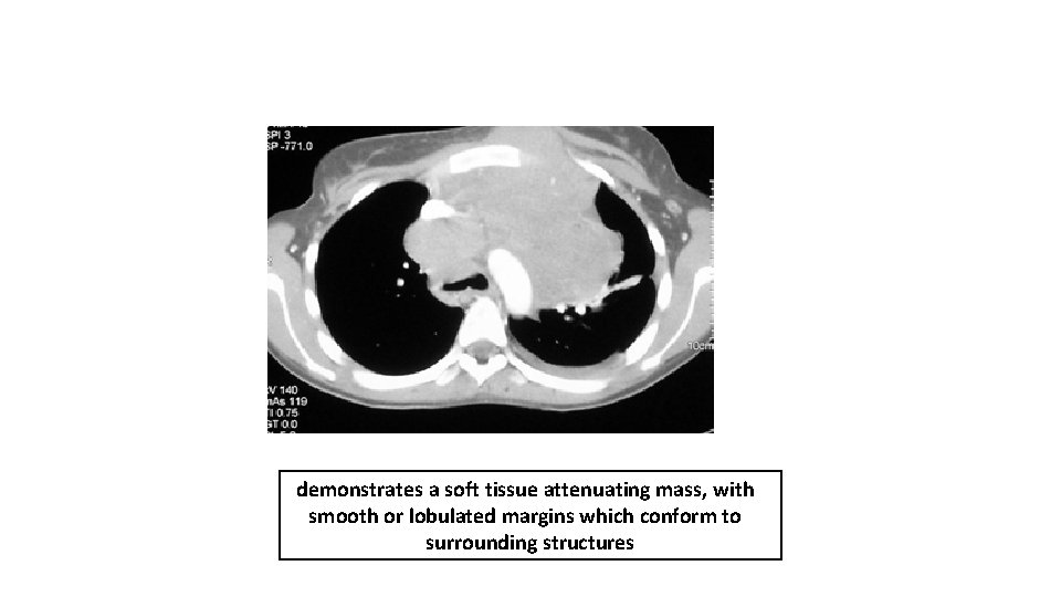 demonstrates a soft tissue attenuating mass, with smooth or lobulated margins which conform to