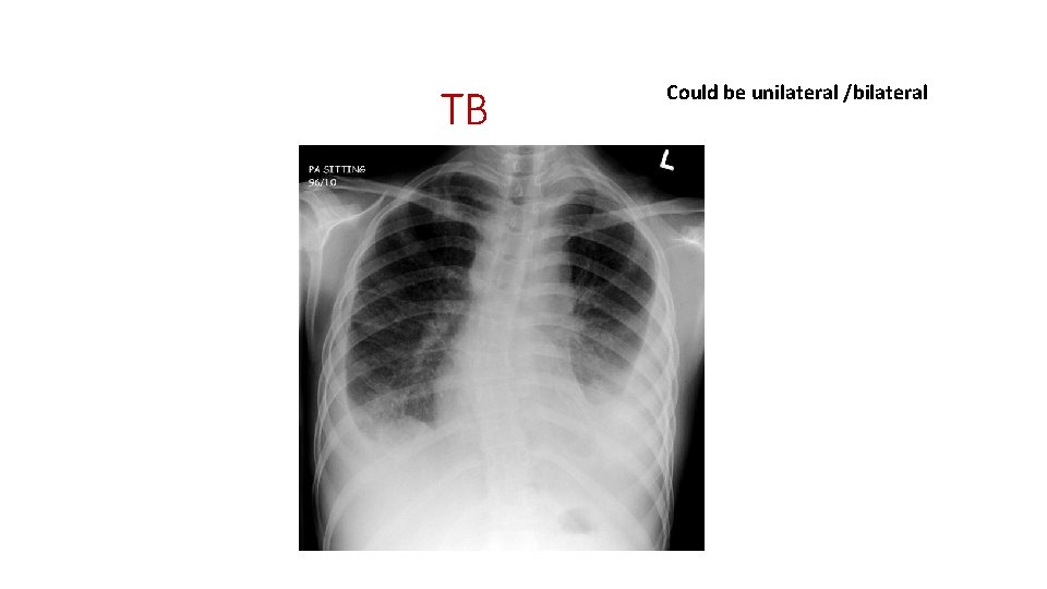 TB Could be unilateral /bilateral 