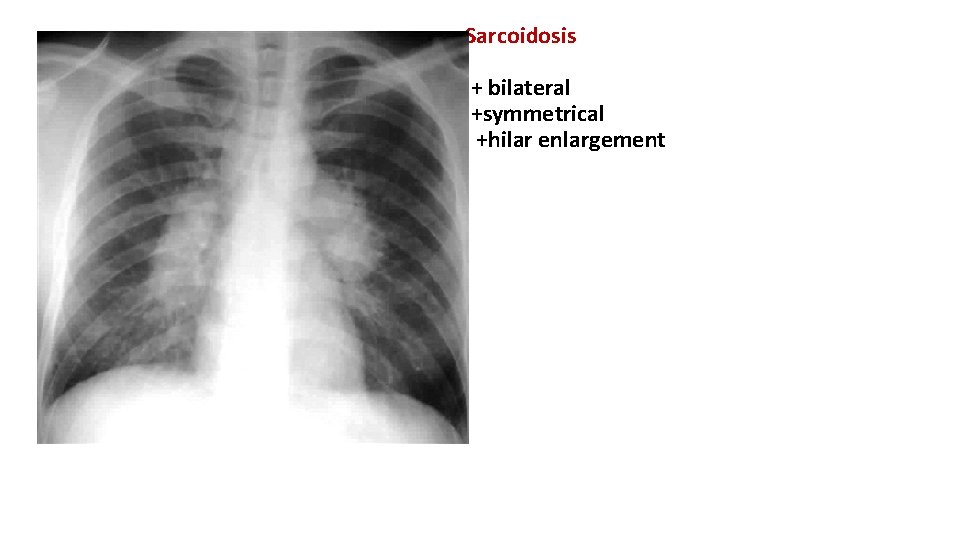 Sarcoidosis + bilateral +symmetrical +hilar enlargement 