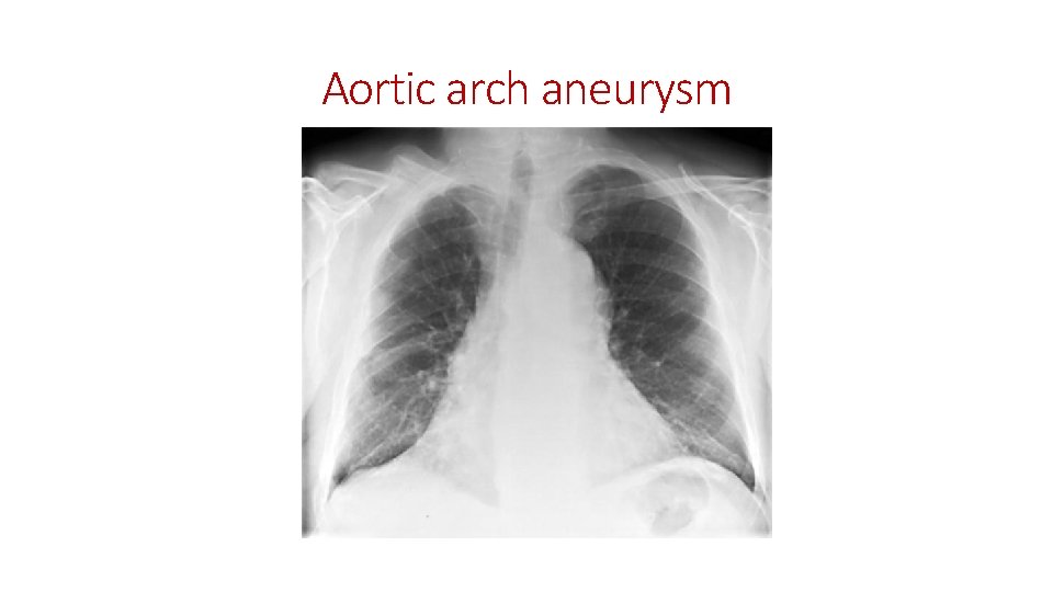 Aortic arch aneurysm 