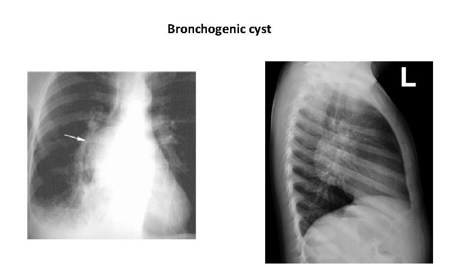 Bronchogenic cyst 