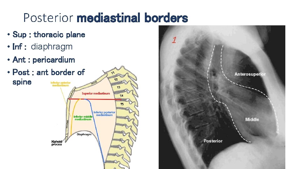 Posterior mediastinal borders • Sup : thoracic plane • Inf : diaphragm • Ant