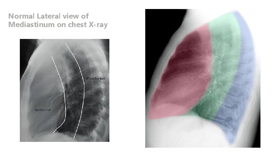 Normal Lateral view of Mediastinum on chest X-ray 