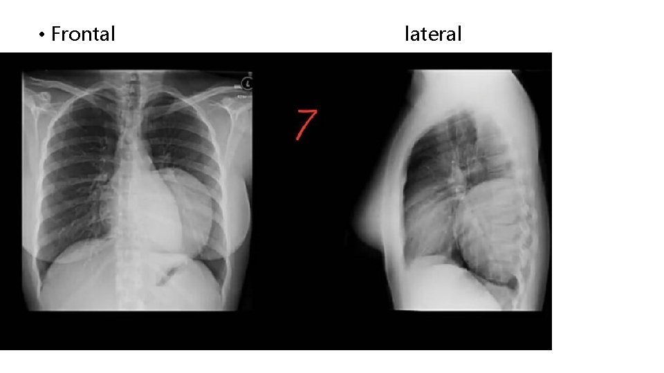  • Frontal lateral 