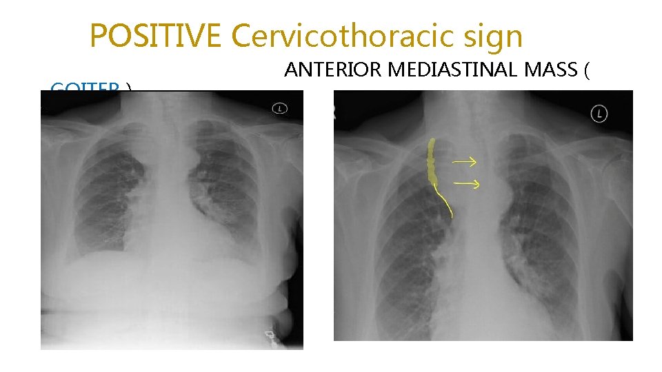 POSITIVE Cervicothoracic sign GOITER ) ANTERIOR MEDIASTINAL MASS ( 