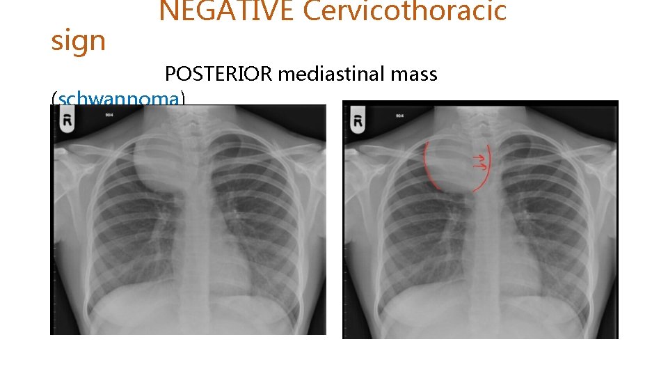 sign NEGATIVE Cervicothoracic POSTERIOR mediastinal mass (schwannoma) 