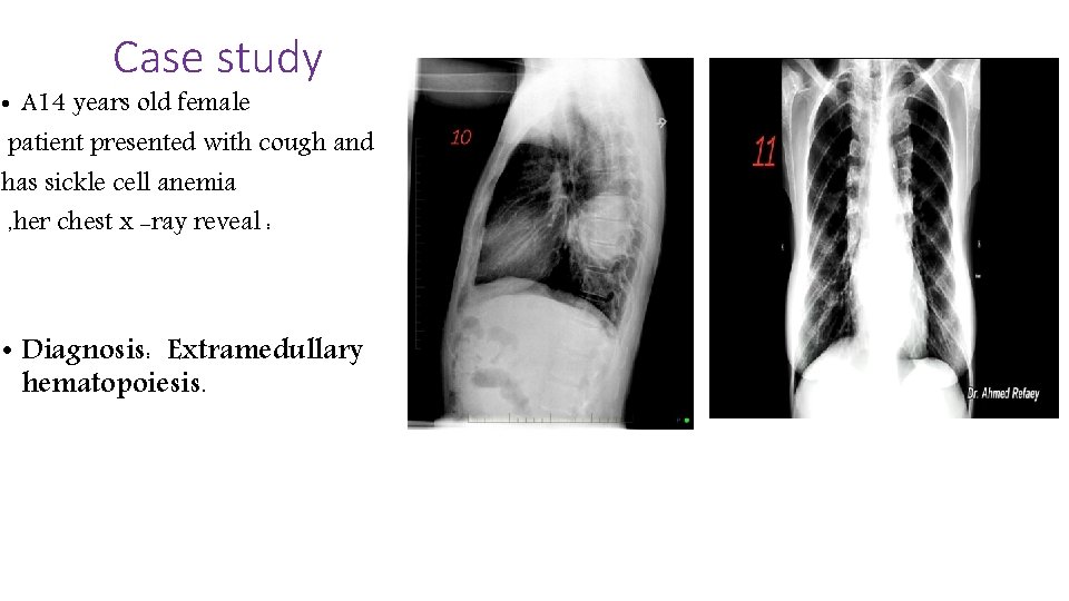 Case study • A 14 years old female patient presented with cough and has